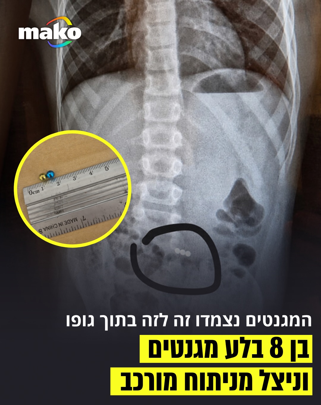 גילעד שיחק בחדרו כשברגע של שעמום הכניס לפיו שלושה מגנטים...