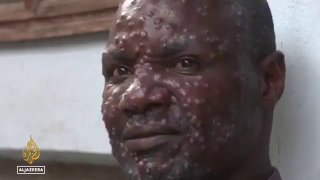 גבר עם אבעבועות קופים....